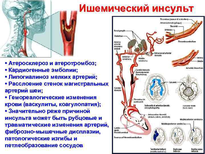 Ишемический инсульт • Атеросклероз и атеротромбоз; • Кардиогенные эмболии; • Липогиалиноз мелких артерий; •