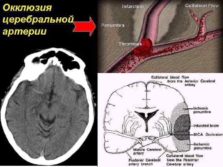 Окклюзия церебральной артерии 