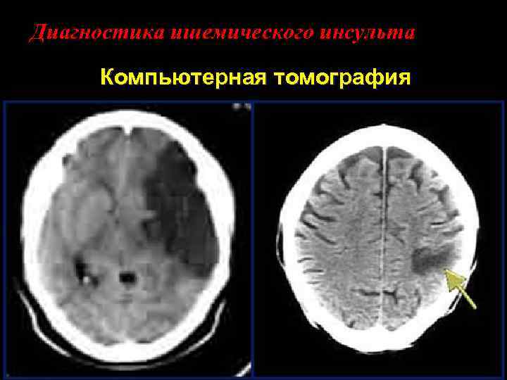 Диагностика ишемического инсульта Компьютерная томография 