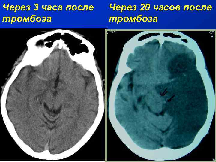 Через 3 часа после тромбоза Через 20 часов после тромбоза 