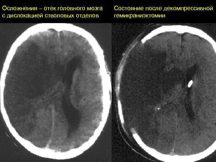 Оттек мозга. Цитотоксический отек головного мозга кт. Вазогенный отек мозга на кт. Токсическое поражение головного мозга кт. Цитотоксический отек головного мозга на мрт.