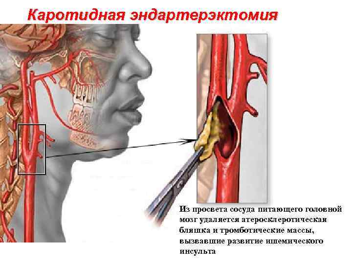 Каротидная эндартерэктомия Из просвета сосуда питающего головной мозг удаляется атеросклеротическая бляшка и тромботические массы,