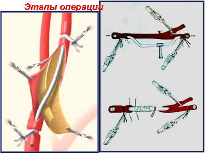 Этапы операции 