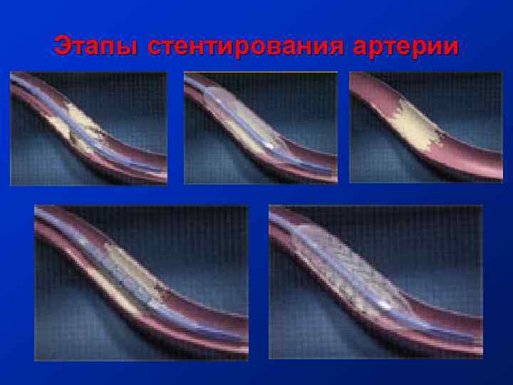 Этапы стентирования артерии 