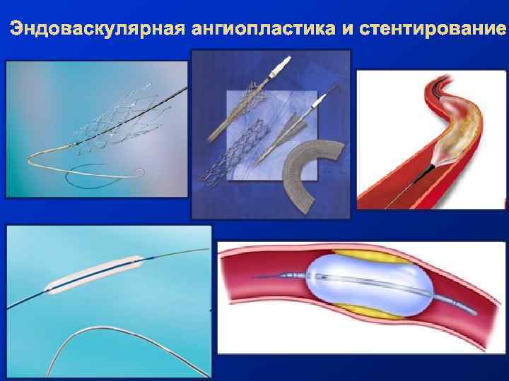 Эндоваскулярная ангиопластика и стентирование 