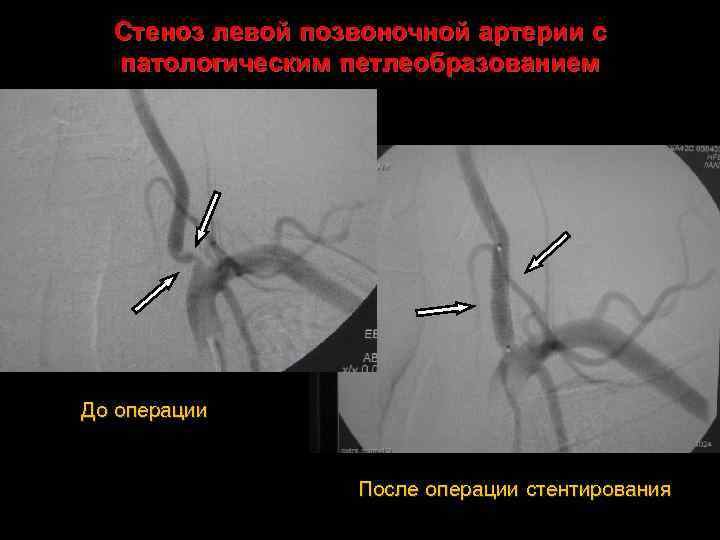 Стеноз левой позвоночной артерии с патологическим петлеобразованием До операции После операции стентирования 