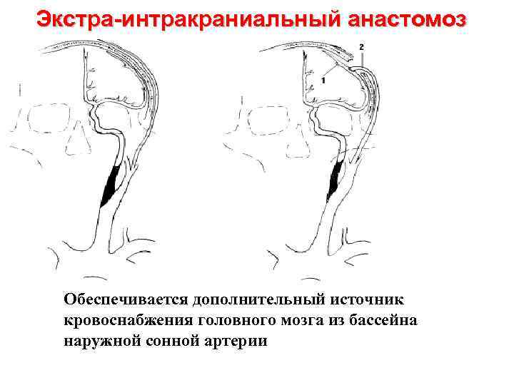 Экстра-интракраниальный анастомоз Обеспечивается дополнительный источник кровоснабжения головного мозга из бассейна наружной сонной артерии 