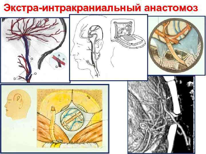 Экстра-интракраниальный анастомоз 