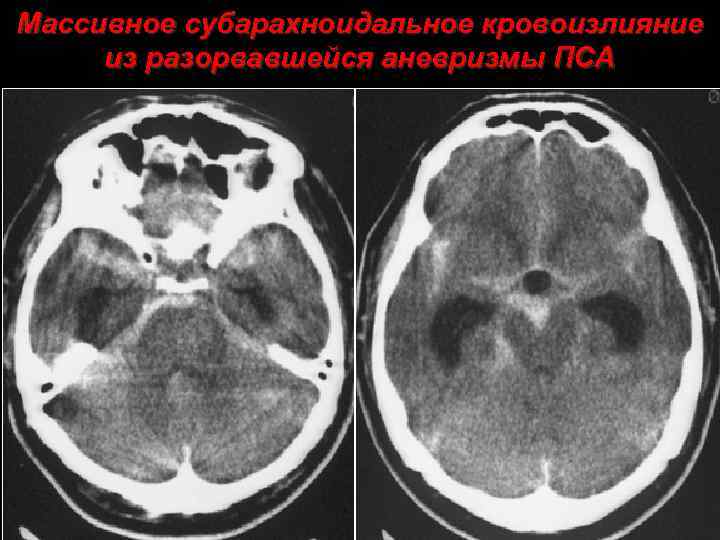 Массивное субарахноидальное кровоизлияние из разорвавшейся аневризмы ПСА 