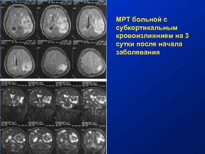 МРТ больной с субкортикальным кровоизлиянием на 3 сутки после начала заболевания 