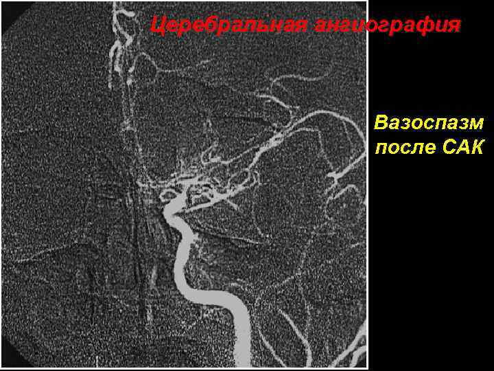 Церебральная ангиография Вазоспазм после САК 