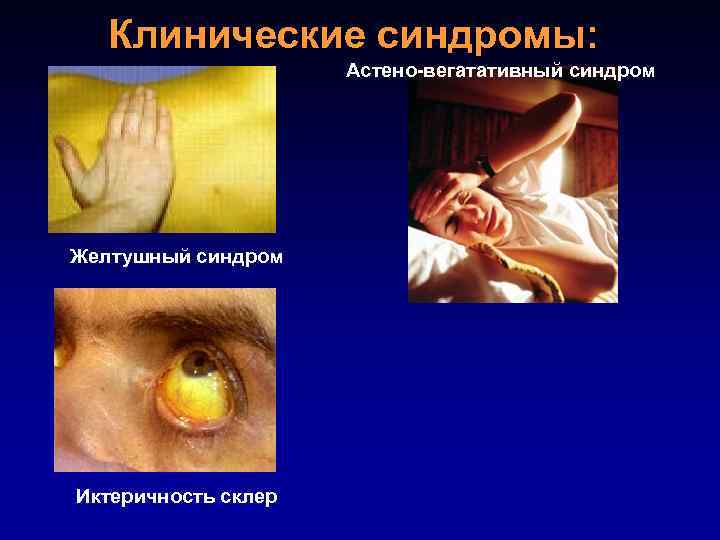 Клинические синдромы: Астено-вегатативный синдром Желтушный синдром Иктеричность склер 