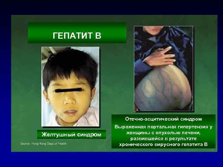 ГЕПАТИТ В Отечно-асцитический синдром Желтушный синдром Выраженная портальная гипертензия у женщины с опухолью печени,