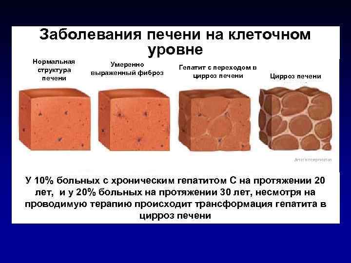 Заболевания печени на клеточном уровне Нормальная структура печени Умеренно выраженный фиброз Гепатит с переходом