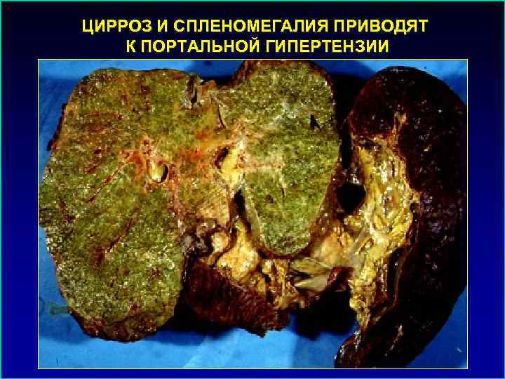 ЦИРРОЗ И СПЛЕНОМЕГАЛИЯ ПРИВОДЯТ К ПОРТАЛЬНОЙ ГИПЕРТЕНЗИИ 