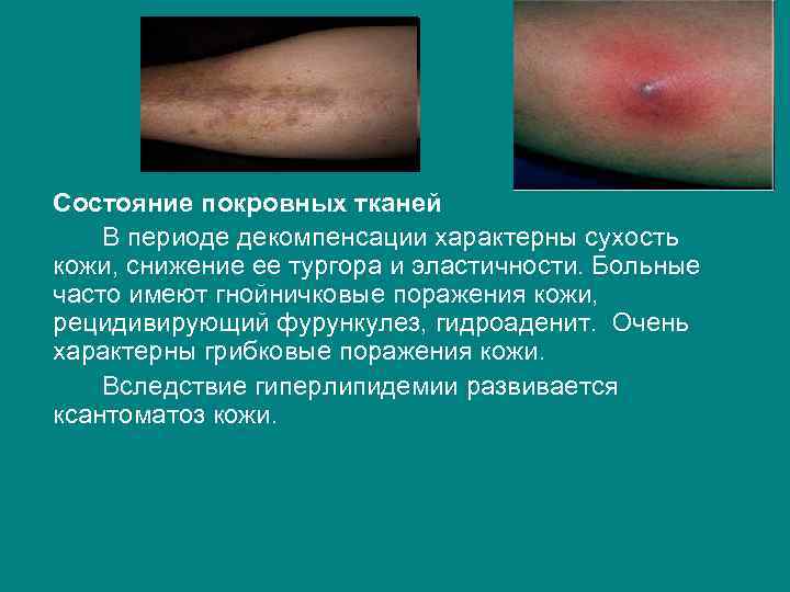 Состояние покровных тканей В периоде декомпенсации характерны сухость кожи, снижение ее тургора и эластичности.