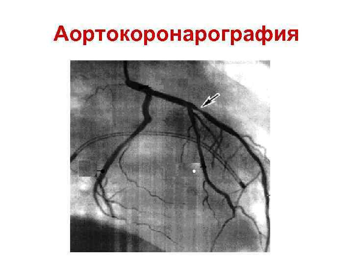 Аортокоронарография 