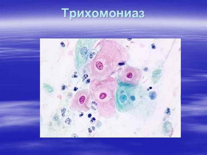 Трихомониаз 