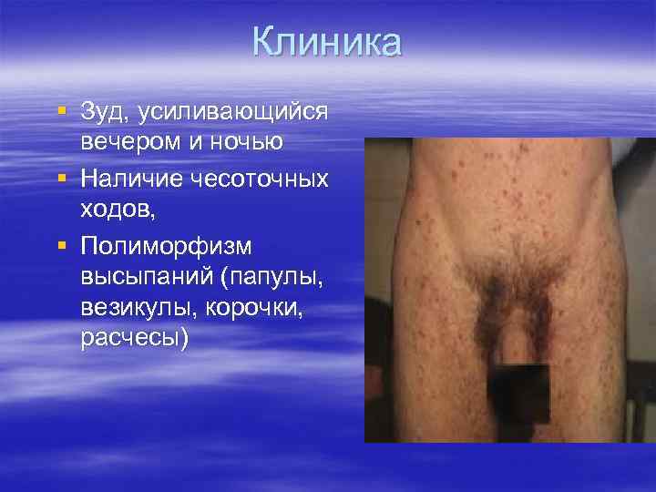 Клиника § Зуд, усиливающийся вечером и ночью § Наличие чесоточных ходов, § Полиморфизм высыпаний