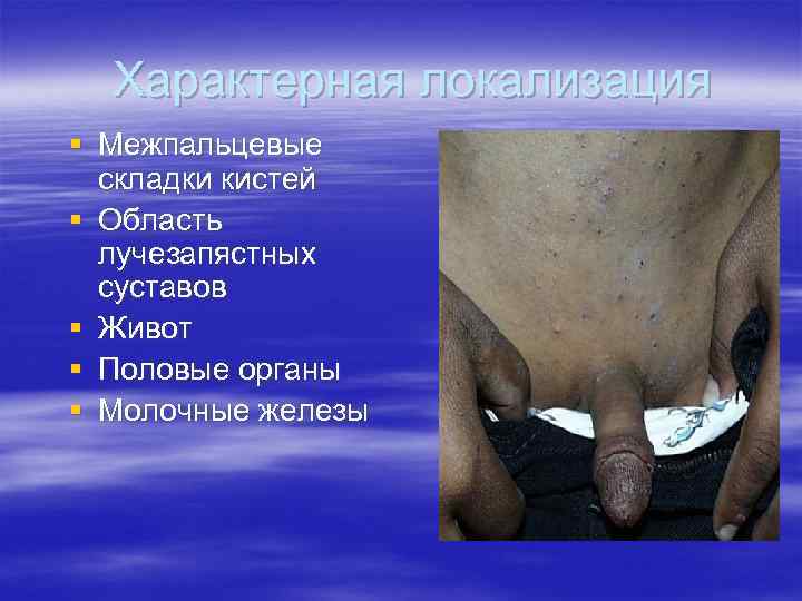 Характерная локализация § Межпальцевые складки кистей § Область лучезапястных суставов § Живот § Половые