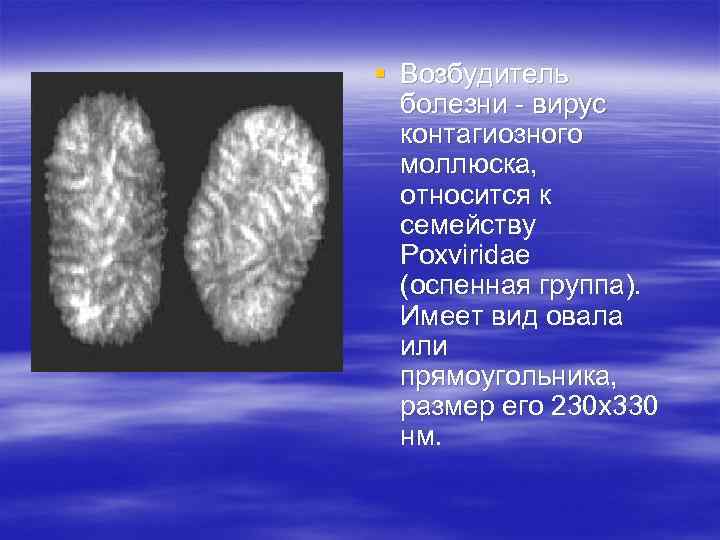 § Возбудитель болезни - вирус контагиозного моллюска, относится к семейству Poxviridae (оспенная группа). Имеет