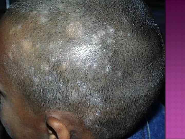   Трихофития волосистой части головы • Множественные  изолированные небольшие очаги (до 2