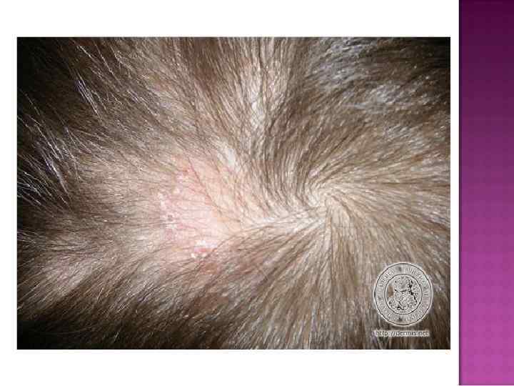 Формирование инфильтратов – керион Цельса  • Инфильтрат до 6 -8 см , выпуклой