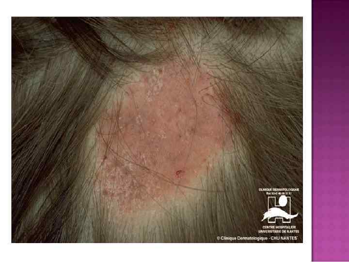 Характерен глубокий микоз-инфильтративно-нагноительная форма Крупные узлы синюшно красного цвета Четкие границы, бугристая поверхность На