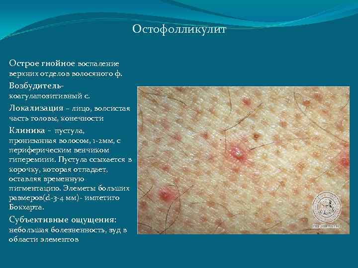 Остофолликулит Острое гнойное воспаление верхних отделов волосяного ф. Возбудитель- коагулапозитивный с. Локализация – лицо,