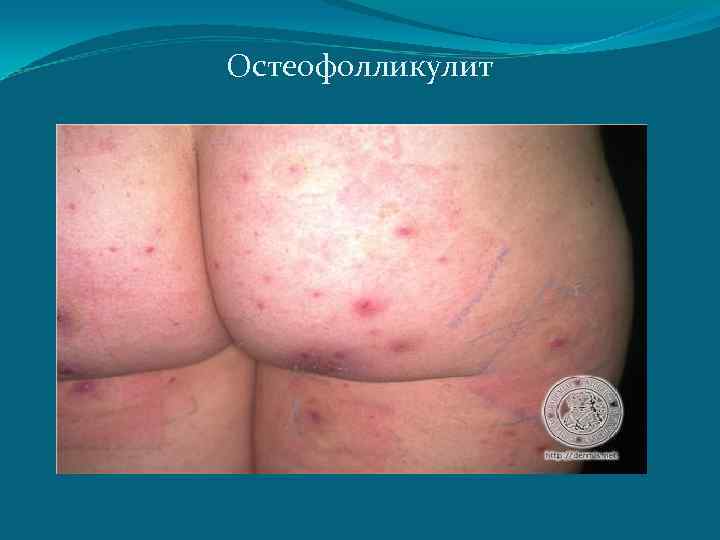 Остеофолликулит 