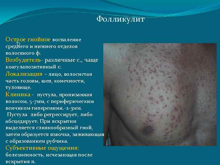 Фолликулит Острое гнойное воспаление О среднего и нижнего отделов волосяного ф. Возбудитель- различные с.