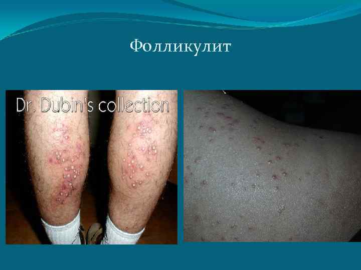Фолликулит 