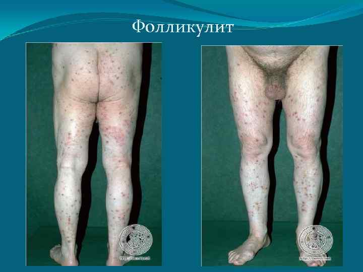 Фолликулит 