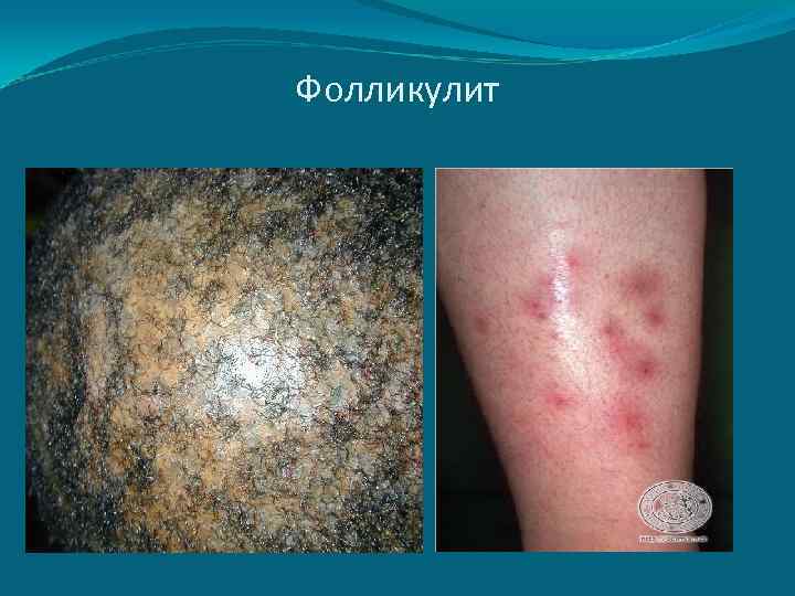 Фолликулит 