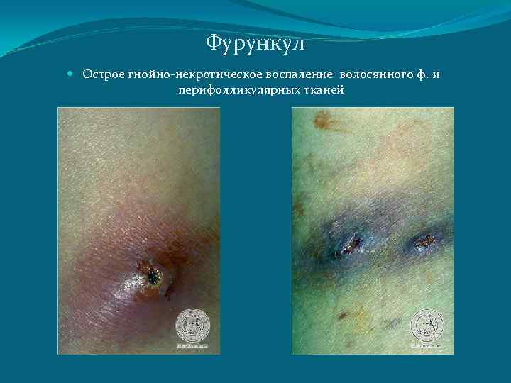 Фурункул Острое гнойно-некротическое воспаление волосянного ф. и перифолликулярных тканей 