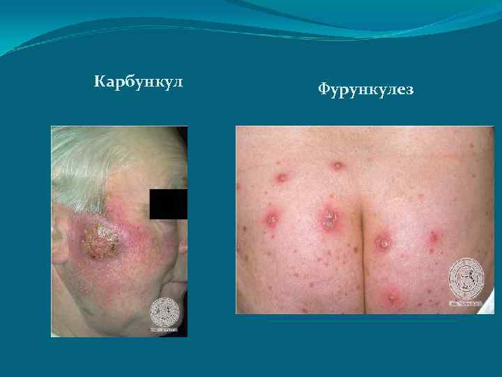 Карбункул Фурункулез 