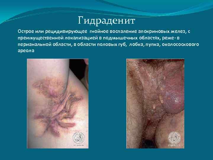 Гидраденит Острое или рецидивирующее гнойное воспаление апокриновых желез, с преимущественной локализацией в подмышечных областях,