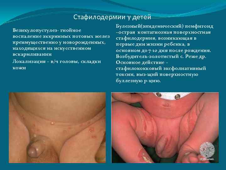 Стафилодермии у детей Везикулопустулез- гнойное воспаление эккринных потовых желез преимущественно у новорожденных, находящихся на