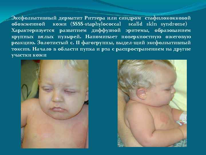 Эксфолиативный дерматит Риттера или синдром стафилококковой обожженной кожи (SSSS-staphylococcal scalid skin syndrome) Характеризуется развитием