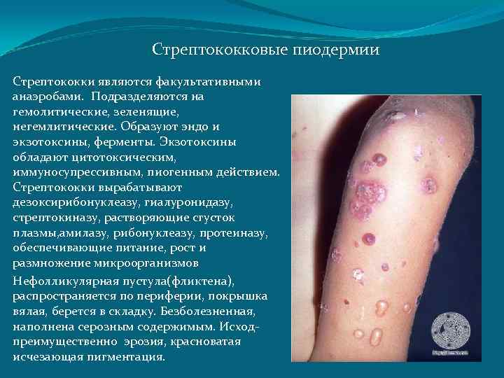 Стрептококковые пиодермии Стрептококки являются факультативными анаэробами. Подразделяются на гемолитические, зеленящие, негемлитические. Образуют эндо и