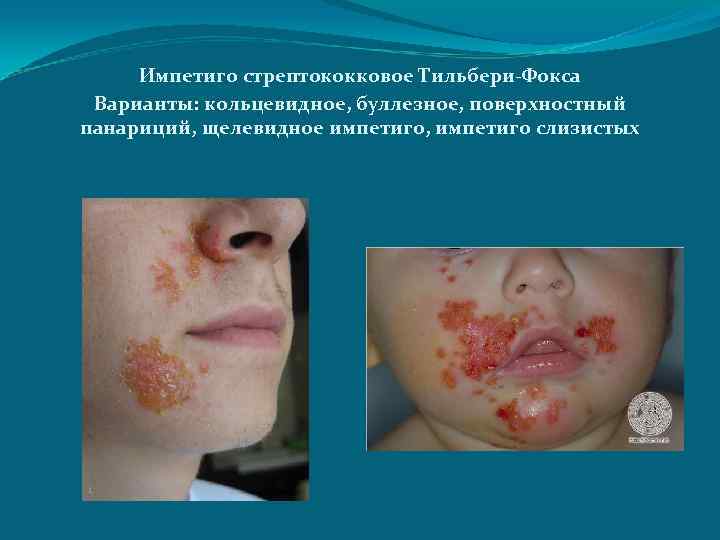 Импетиго стрептококковое Тильбери-Фокса Варианты: кольцевидное, буллезное, поверхностный панариций, щелевидное импетиго, импетиго слизистых 