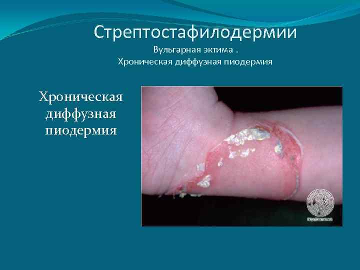 Стрептостафилодермии Вульгарная эктима. Хроническая диффузная пиодермия 