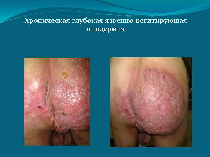 Хроническая глубокая язвенно-вегитирующая пиодермия 