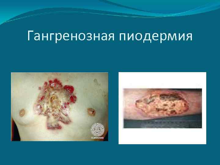 Гангренозная пиодермия 
