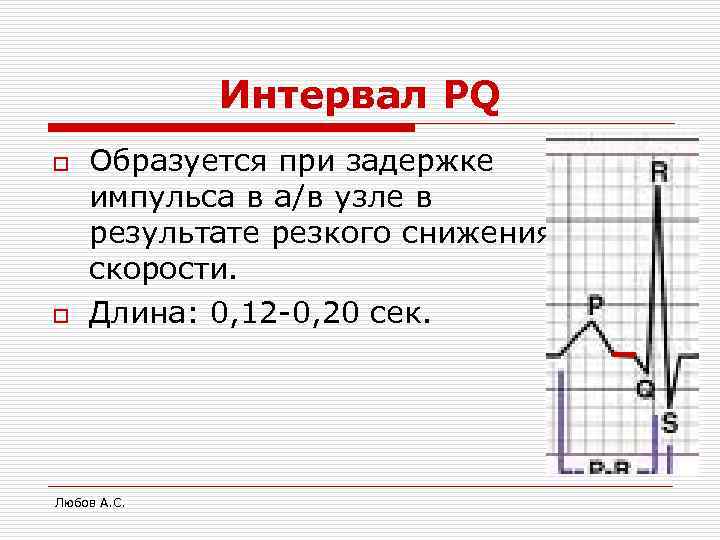 Интервал PQ o o Образуется при задержке импульса в а/в узле в результате резкого