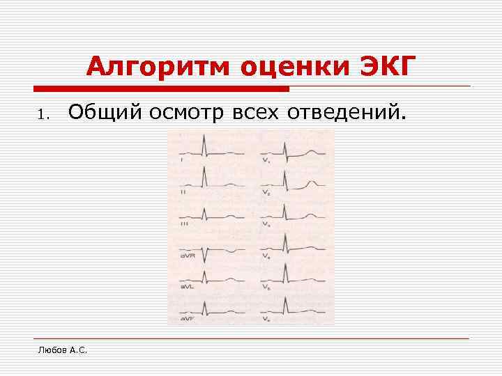 Алгоритм оценки ЭКГ 1. Общий осмотр всех отведений. Любов А. С. 