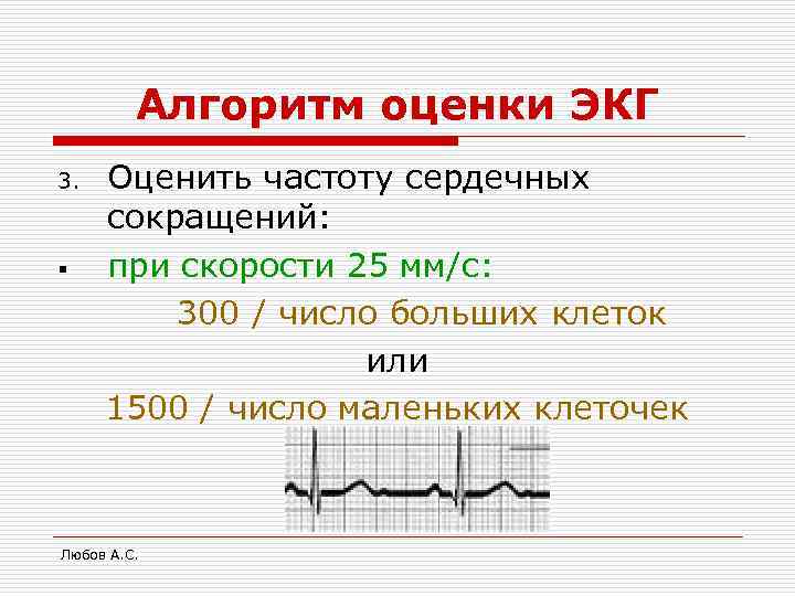 Алгоритм оценки ЭКГ 3. § Оценить частоту сердечных сокращений: при скорости 25 мм/с: 300