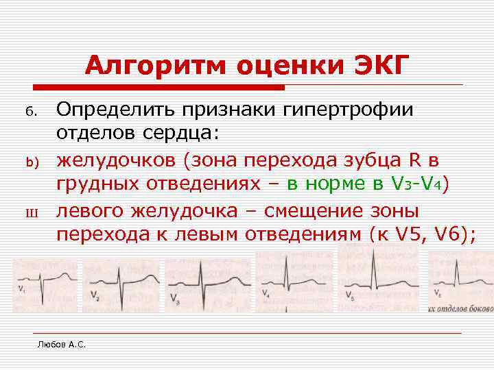 Алгоритм оценки ЭКГ 6. b) Ш Определить признаки гипертрофии отделов сердца: желудочков (зона перехода