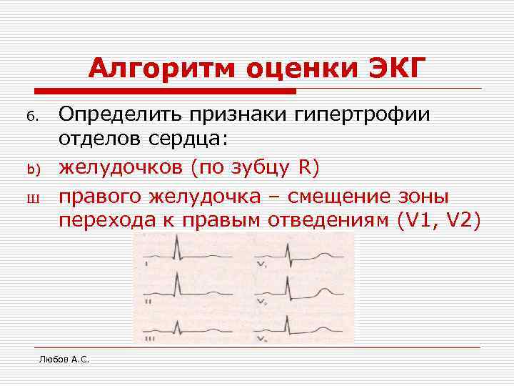 Алгоритм оценки ЭКГ 6. b) Ш Определить признаки гипертрофии отделов сердца: желудочков (по зубцу