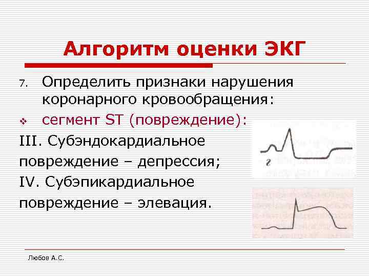 Алгоритм оценки ЭКГ Определить признаки нарушения коронарного кровообращения: v сегмент ST (повреждение): III. Субэндокардиальное